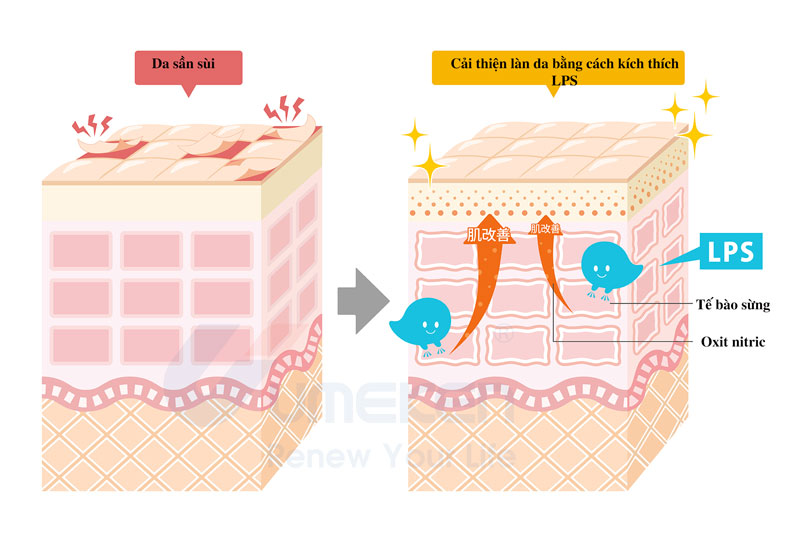 Lớp ngoài cùng của da chúng ta là lớp biểu bì và bên dưới là lớp hạ bì. Lớp biểu bì bao gồm bốn lớp: lớp sừng, lớp hạt, lớp gai và lớp đáy.
LPS không thể đi xuống bên dưới mối nối chặt chẽ này, nhưng các tế bào sừng tạo nên da và các tế bào T điều tiết ngăn chặn tình trạng viêm có các thụ thể nhận tín hiệu LPS. Do đó , mặc dù LPS không thể xâm nhập vào da nhưng nó có thể gửi tín hiệu đến hệ thống miễn dịch của da và kích hoạt chức năng miễn dịch của nó .
Chúng ta hãy xem xét kỹ hơn LPS ảnh hưởng đến vết thương như thế nào.
Sửa chữa vết thương tiến hành bởi các tế bào miễn dịch như đại thực bào
Trong cơ thể chúng ta, có các tế bào miễn dịch như đại thực bào ăn và tiêu diệt vi khuẩn đã xâm nhập cơ thể và ngăn ngừa nhiễm trùng do vi khuẩn.
Khi da bị thương hoặc giác mạc của mắt bị tổn thương, phản ứng với LPS tăng lên và các cytokine được tạo ra để truyền thông tin để sửa chữa các tế bào. Sau đó, các cytokine tập hợp các tế bào miễn dịch như đại thực bào, và người ta nói rằng quá trình sửa chữa vết thương được đẩy nhanh.
- Oxit Nitric Giúp Vết Thương Nhanh Lành
